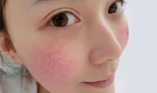 脸上红血丝怎么回事